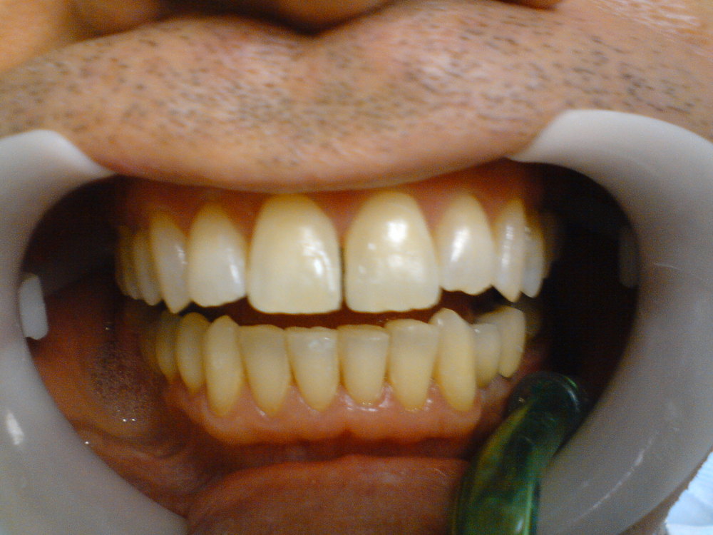 DIASTEMA