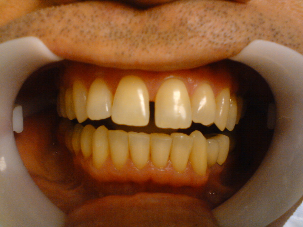 DIASTEMA